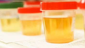 Urine  test pathology lab in Delhi